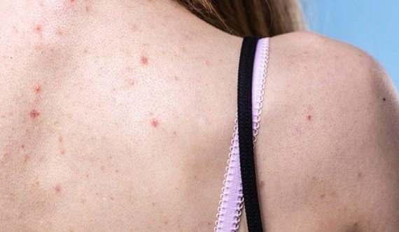 Nëse trupi po ju jep këto sinjale atëherë mund të keni probleme hormonale